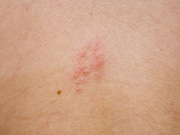 Treatment For Herpes Zoster Shingles